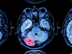 A Brain CT Scan result